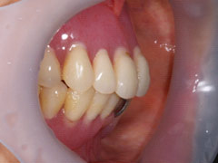 義歯治療1