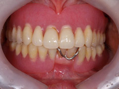 義歯治療3