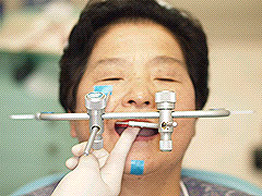 義歯治療7