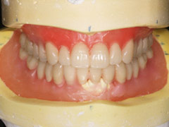 義歯治療9