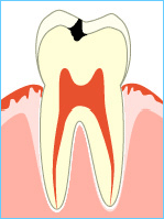 虫歯進行のC1画像