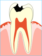 虫歯進行のC2画像