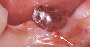 歯内の膿の症状例