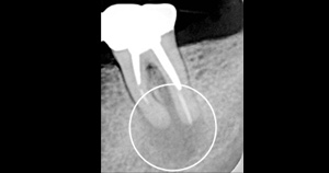 歯内のレントゲン写真