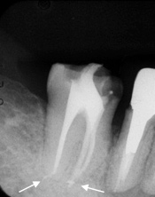 歯内療法治療例1-2