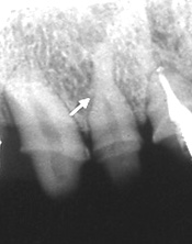 歯内療法治療例3