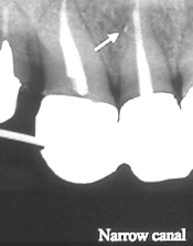 歯内療法治療例3-2