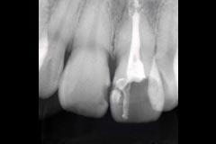 審美歯科治療前3レントゲン写真