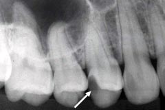 審美歯科治療前4レントゲン写真1
