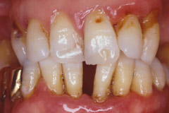 歯周病治療前2