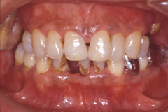 歯周病治療前３