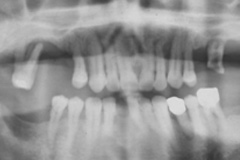 歯周病治療レントゲン３