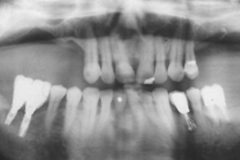 歯周病治療後レントゲン３