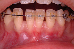 歯周形成治療前１