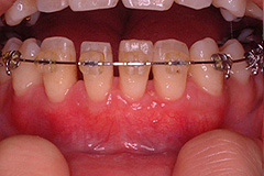 歯周形成治療前２