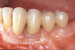 歯周形成治療後２